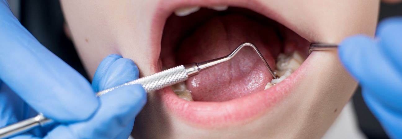 Fillings  Understanding the Procedure and What to Expect